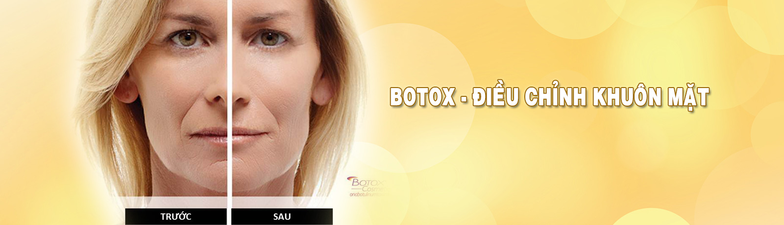 Slide 4 - Botox