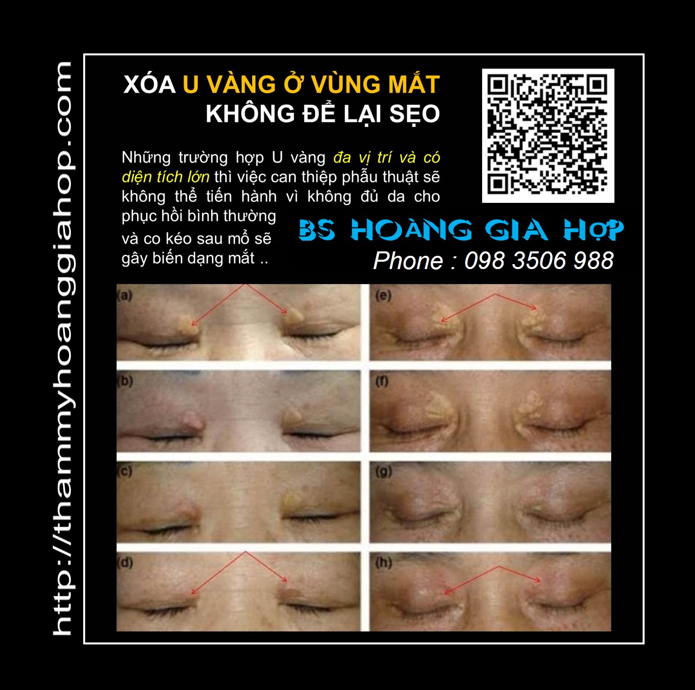 U VÀNG vùng mắt - Cách điều trị không để lại sẹo